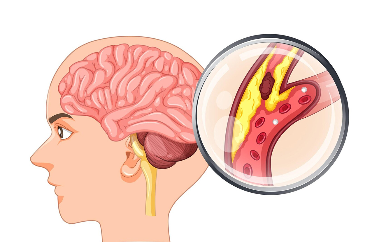Brain Aneurysm Coiling