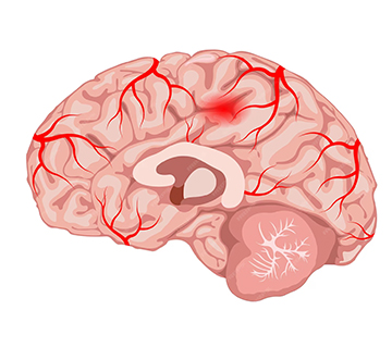Brain Aneurysm